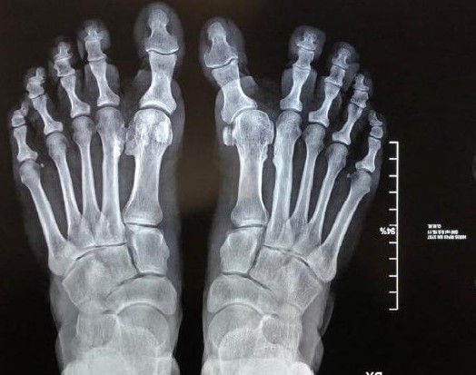 Alluce varo | patologia del piede