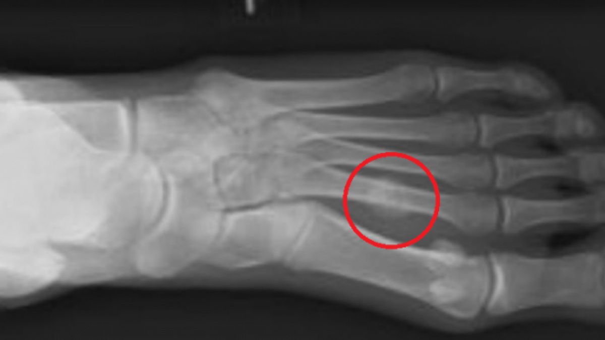 fratture da stress | patologia del piede