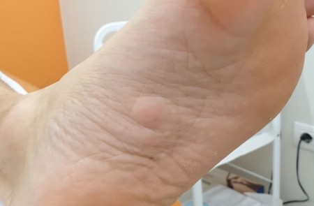 Morbo di Ledderhose | patologia del piede