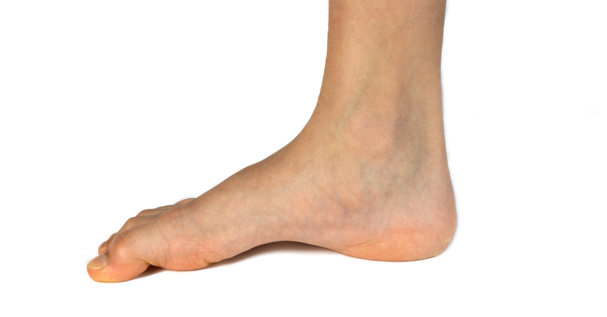 Piede cavo - valgo | patologia del piede