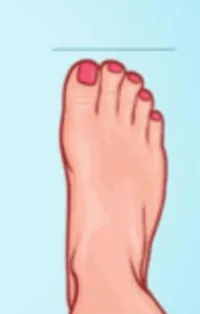 Piede quadro | patologia del piede