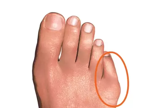 quinto dito varo | patologia del piede