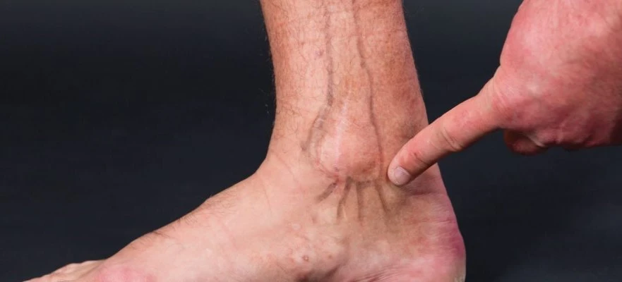 Sindrome del tunnel tarsale | patologia del piede